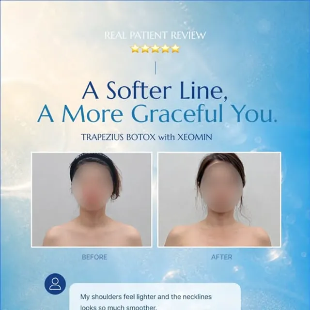 Patient review — trapezius botox with Xeomin at Lijin Clinic Myeongdong
